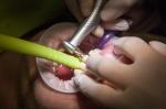 hands on tooth implant training