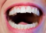 dental bone graft class